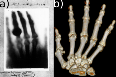 Patient-Specific Prosthetic Fingers by Remote Collaboration–A Case